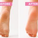  90 Minute Foot Renewal Mask – Exfoliating Foot Peel