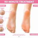  90 Minute Foot Renewal Mask – Exfoliating Foot Peel